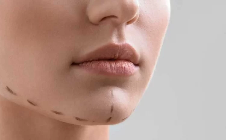  Implant de menton