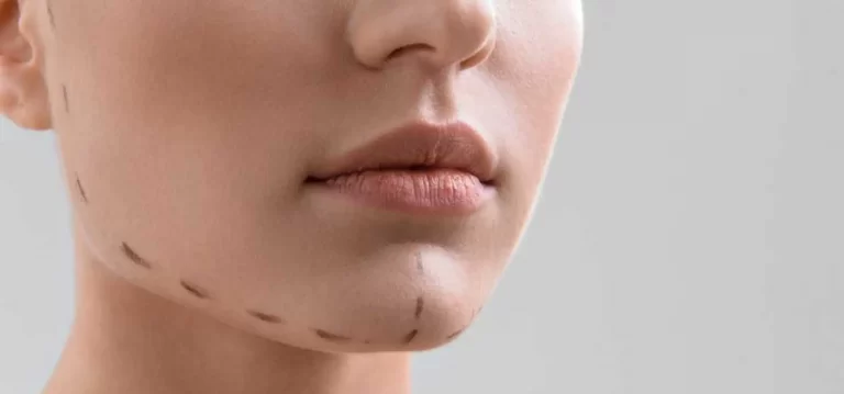 Augmentation du menton