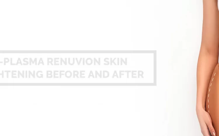 J-plasma (skin tightening technique)
