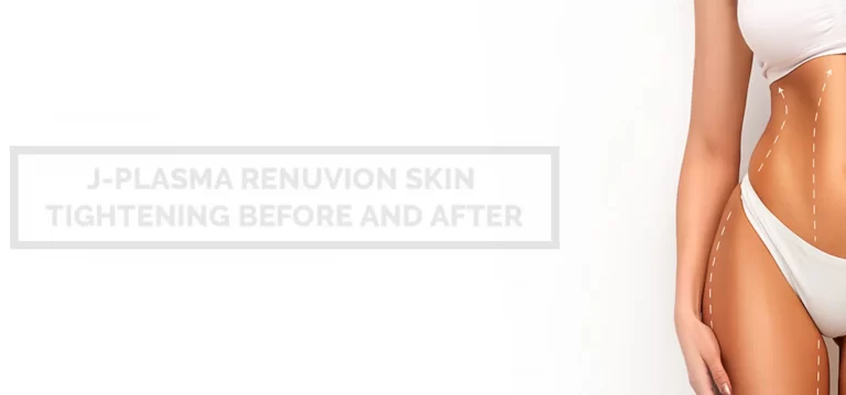 J-plasma (skin tightening technique)