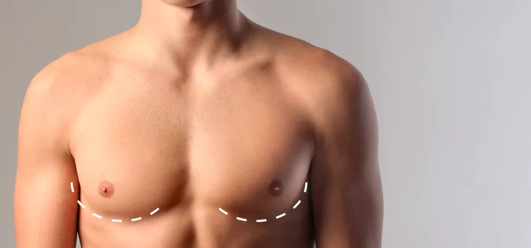 Chirurgie de la gynécomastie [réduction mammaire masculine]