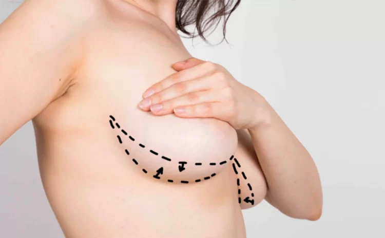  La chirurgie de réduction mammaire