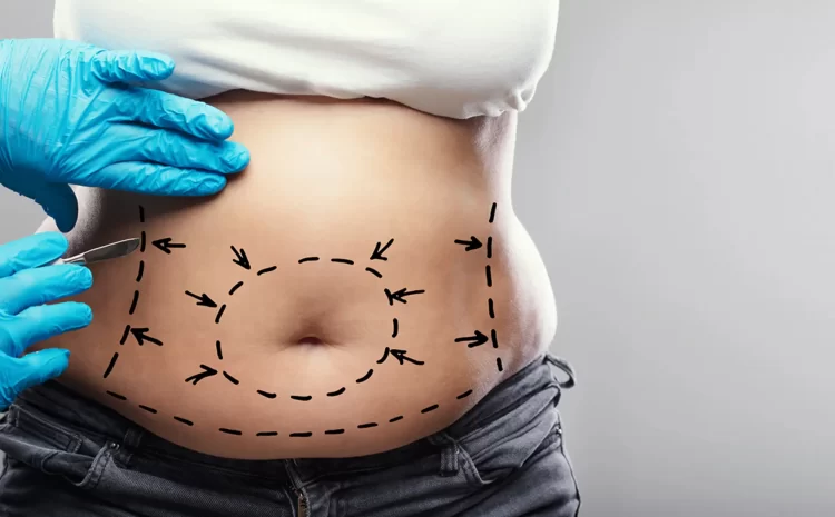 Tummy Tuck (Abdominoplasty)