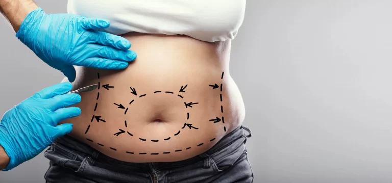 Tummy Tuck (Abdominoplasty)