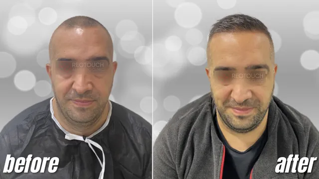 Norwood 4 Full Coverage 4,600 Grafts Before and After
