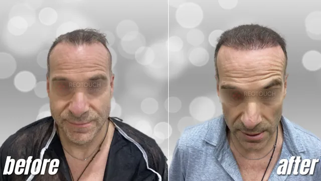 Mature Hairline 3,500 Grafts Before and After