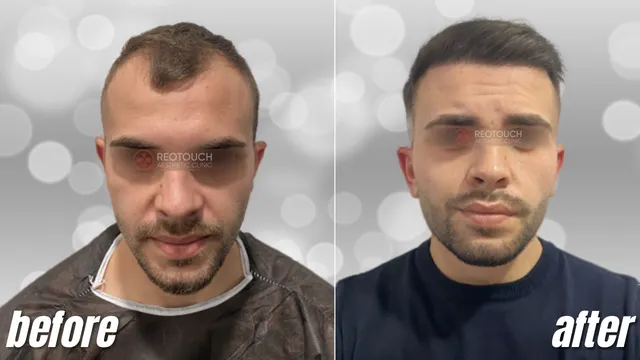 Sapphire FUE 4,200 Grafts Before and After Estelity Clinic