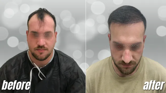 DHI Technique 3,800 Grafts Before and After Estelity Clinic