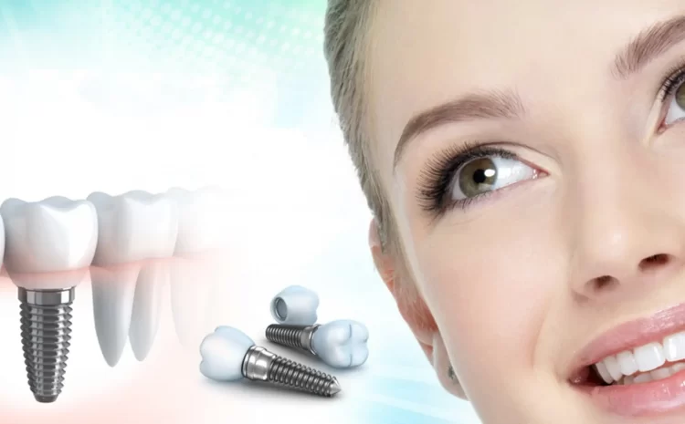  Dental Implants