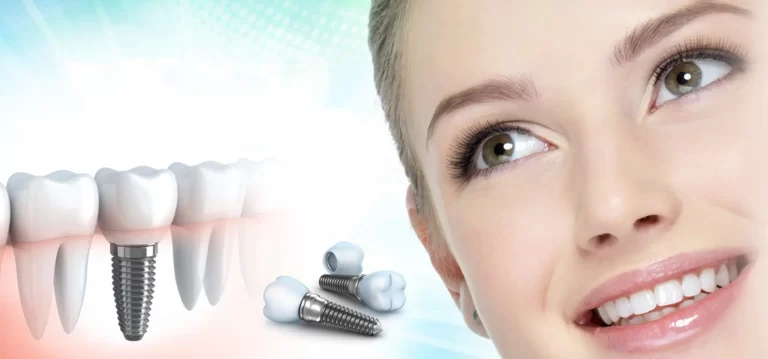Dental Implants
