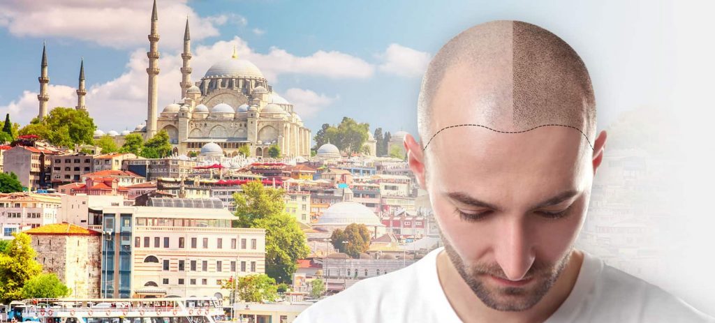 What Is Hair Transplantation?