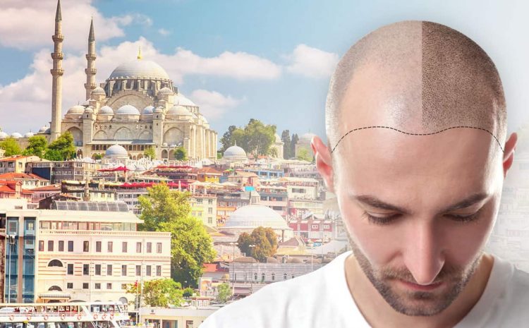 What Is Hair Transplantation?