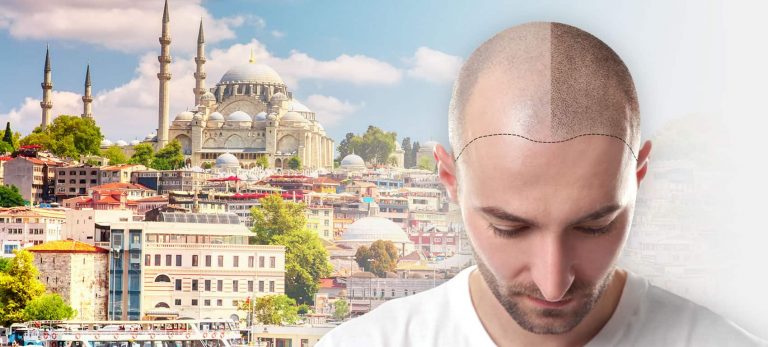 What Is Hair Transplantation?
