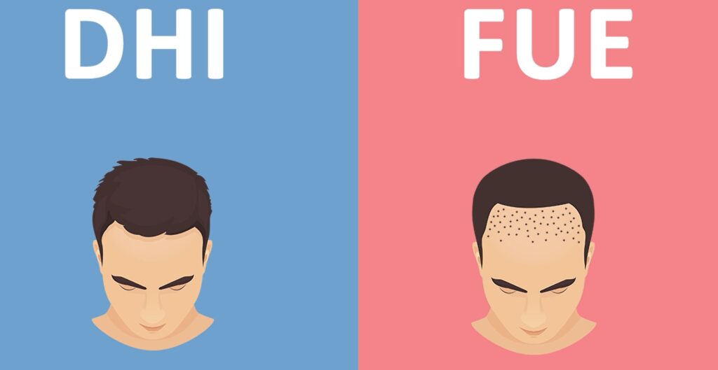 FUE and DHI Hair Transplant: Which is Right for You?