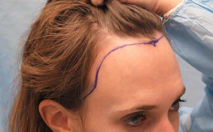 Hair Transplant for Women at Estelity Istanbul