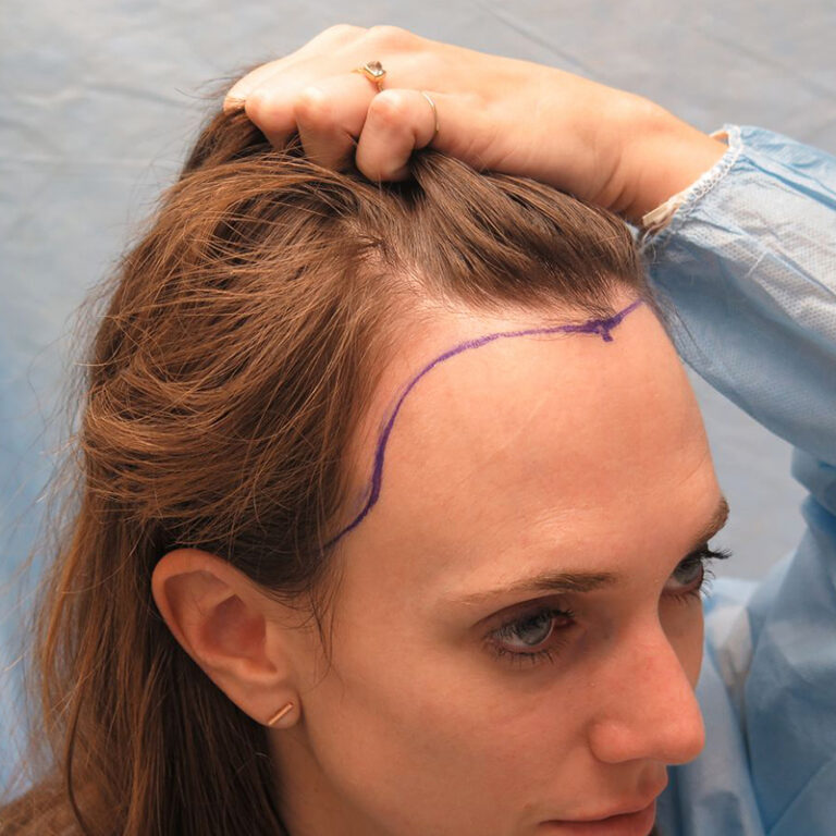 Hair Transplant for Women at Estelity Istanbul