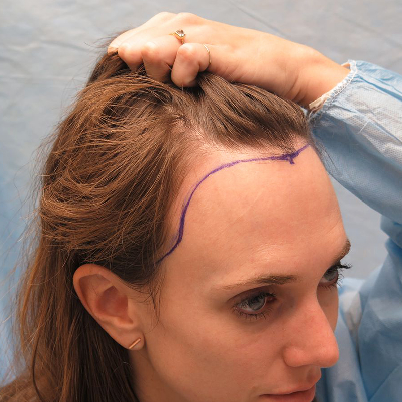 Hair Transplant for Women at Estelity Istanbul