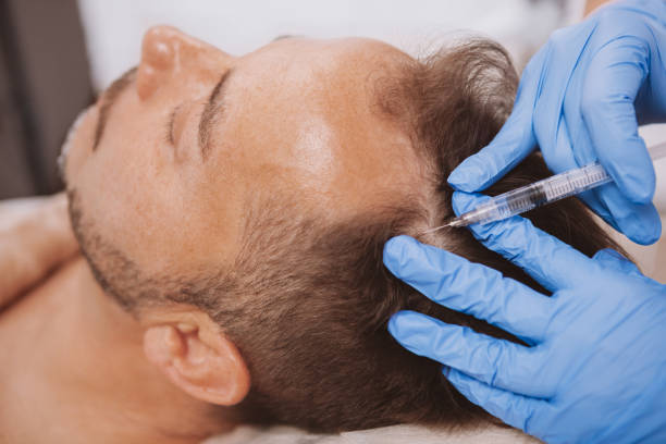 Hair Transplant with PRP Therapy at Estelity