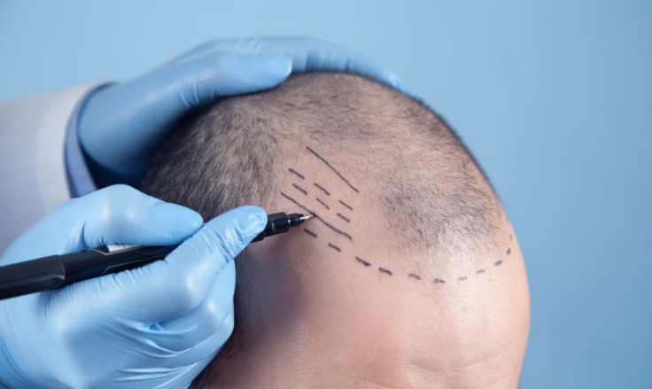 Top Tips for Hair Transplant Recovery in Istanbul