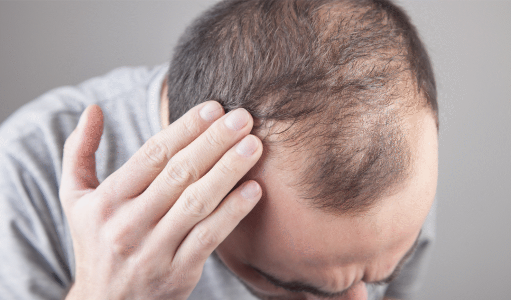 How to Prepare for a Hair Transplant at Estelity