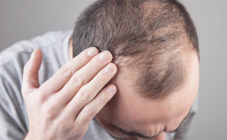 How to Prepare for a Hair Transplant at Estelity
